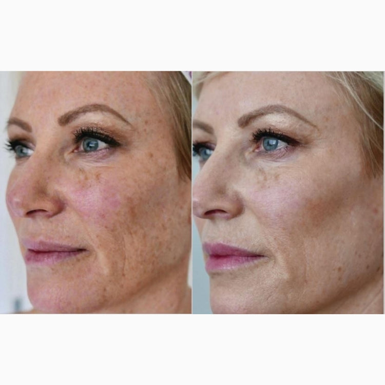 HALO Laser Skin Resurfacing Course of 2 (save up to €801)