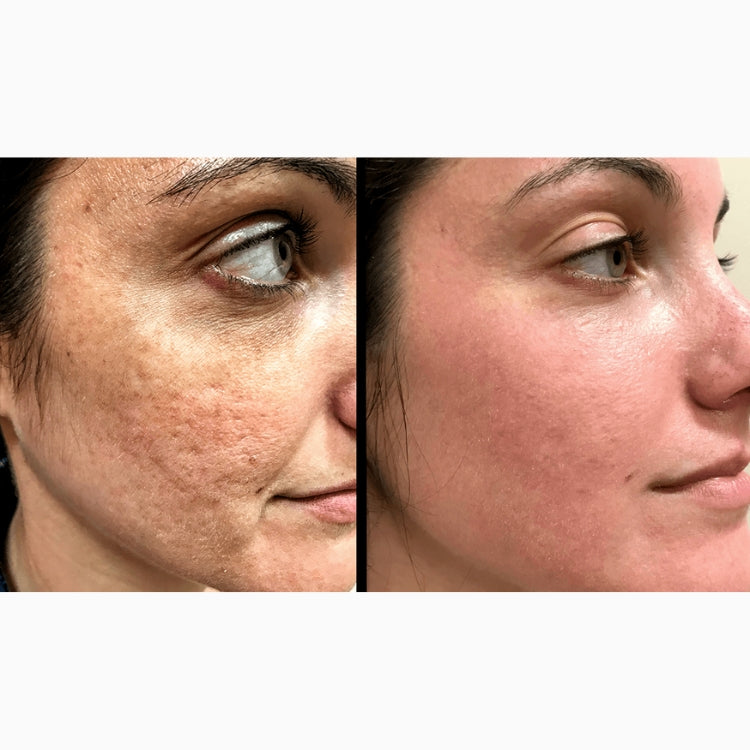 HALO Laser Skin Resurfacing Course of 2 (save up to €801)