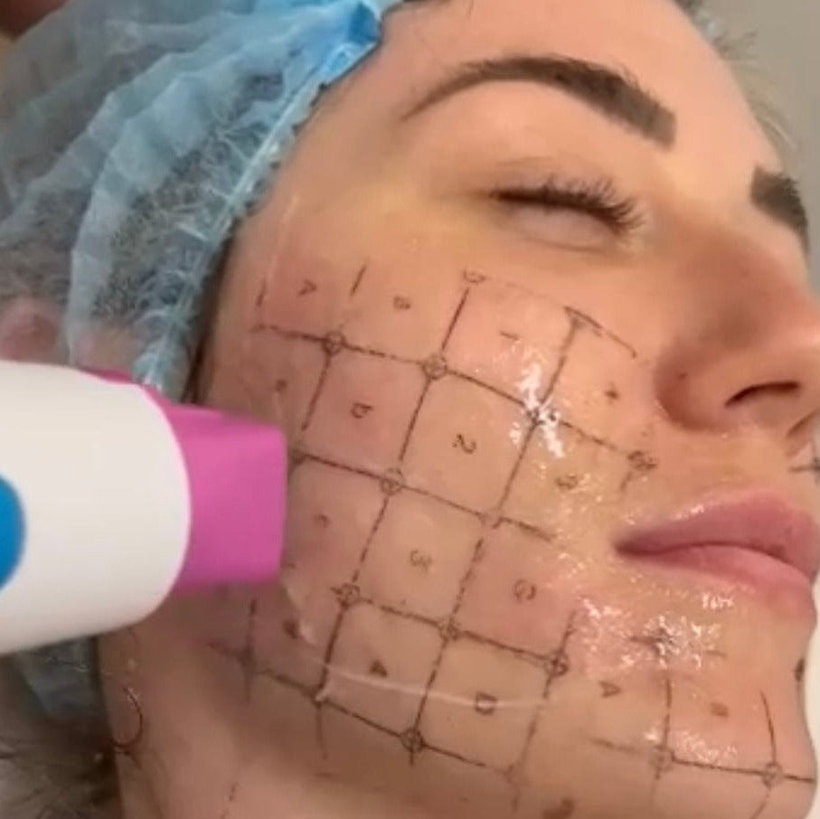 Thermage RF Anti-Ageing Skin Tightening Treatment (save €251)