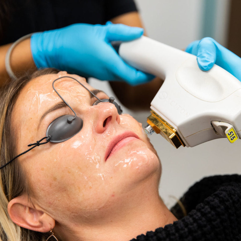 BBL Laser Skin Rejuvenation Course of 3 (save up to €301)