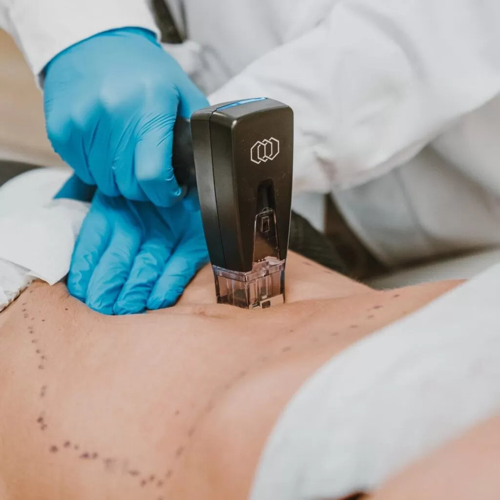 Morpheus8 Deep RF Microneedling for Body Area course of 3 (save up to €2251)
