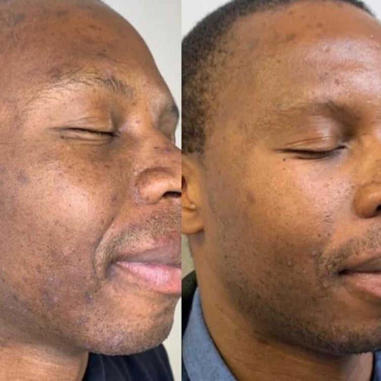 MOXI Laser Skin Rejuvenation course of 2 (save up to €501)