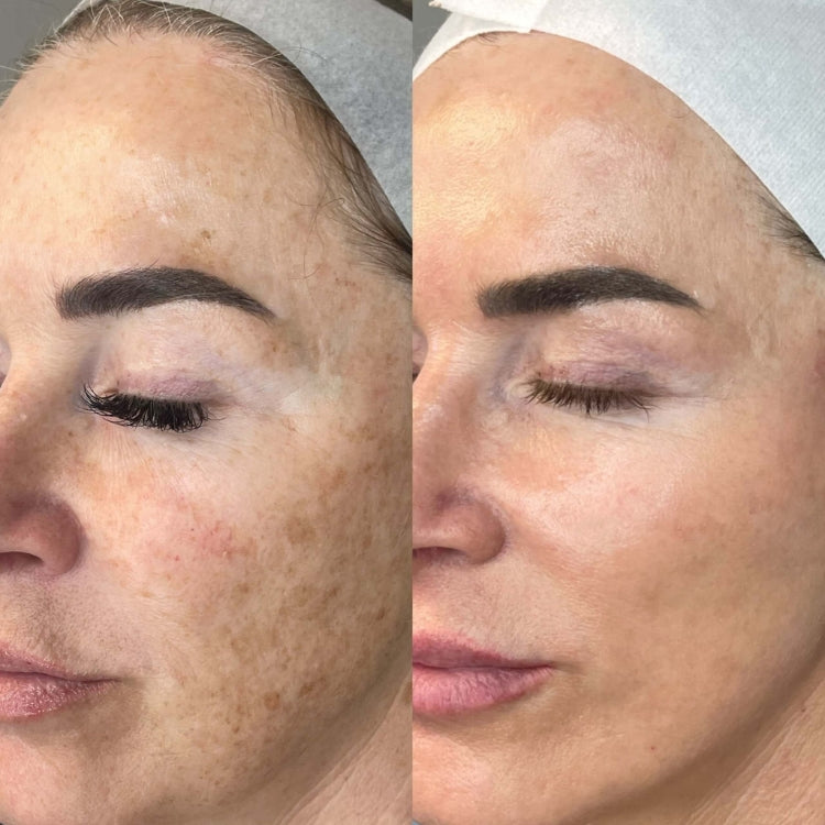 MOXI Laser Skin Rejuvenation course of 2 (save up to €501)