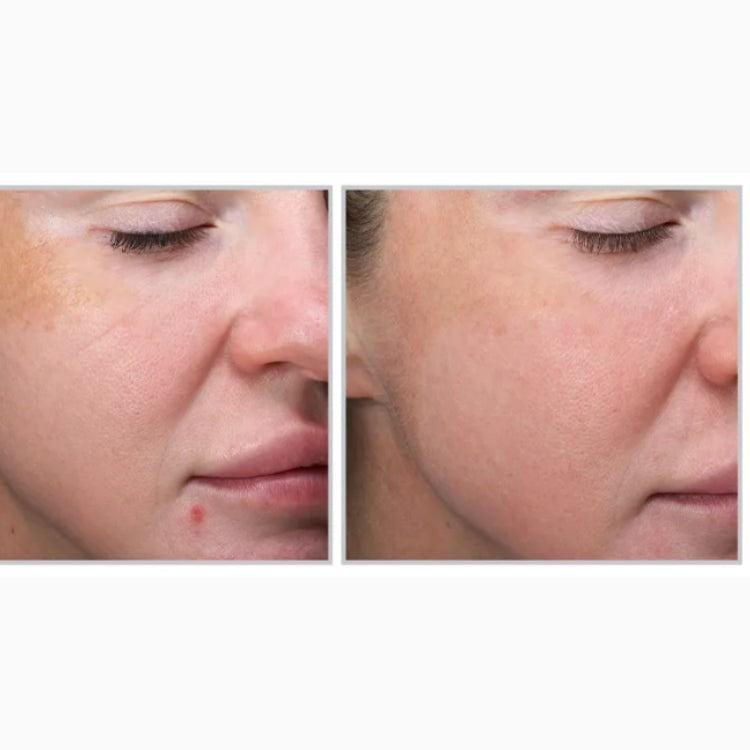 MOXI Laser Skin Rejuvenation course of 2 (save up to €501)