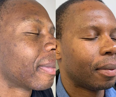 MOXI Laser Skin Rejuvenation Single Session (save €101)