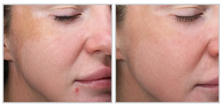 MOXI Laser Skin Rejuvenation Single Session (save €101)