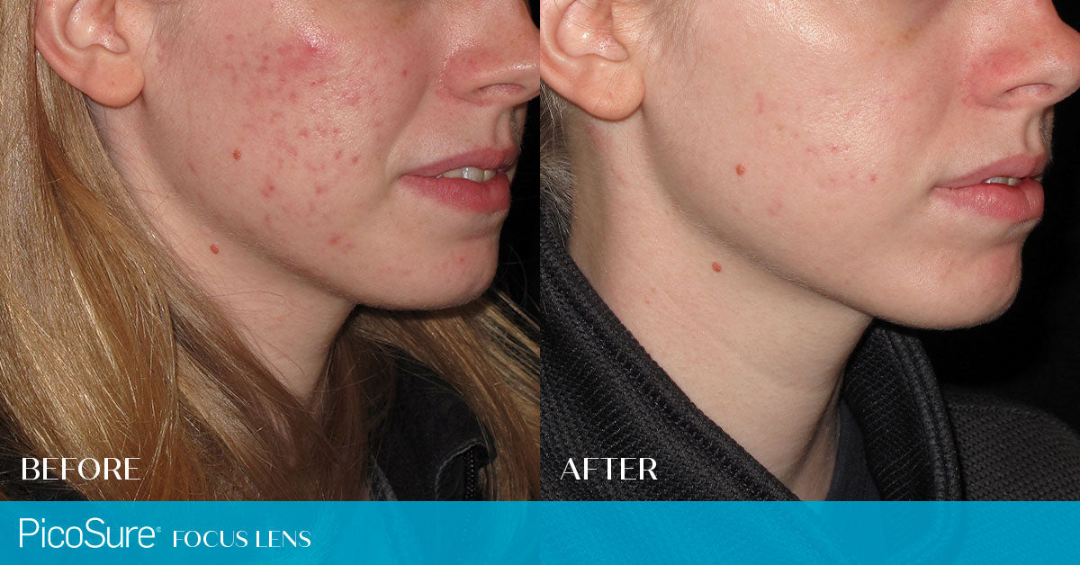 PicoSure Laser Skin Rejuvenation for Pigmentation & Melasma save up to €2,000