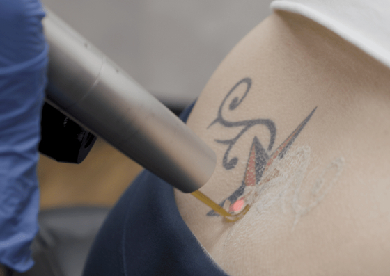 Picosure Laser Tattoo Removal Single Session