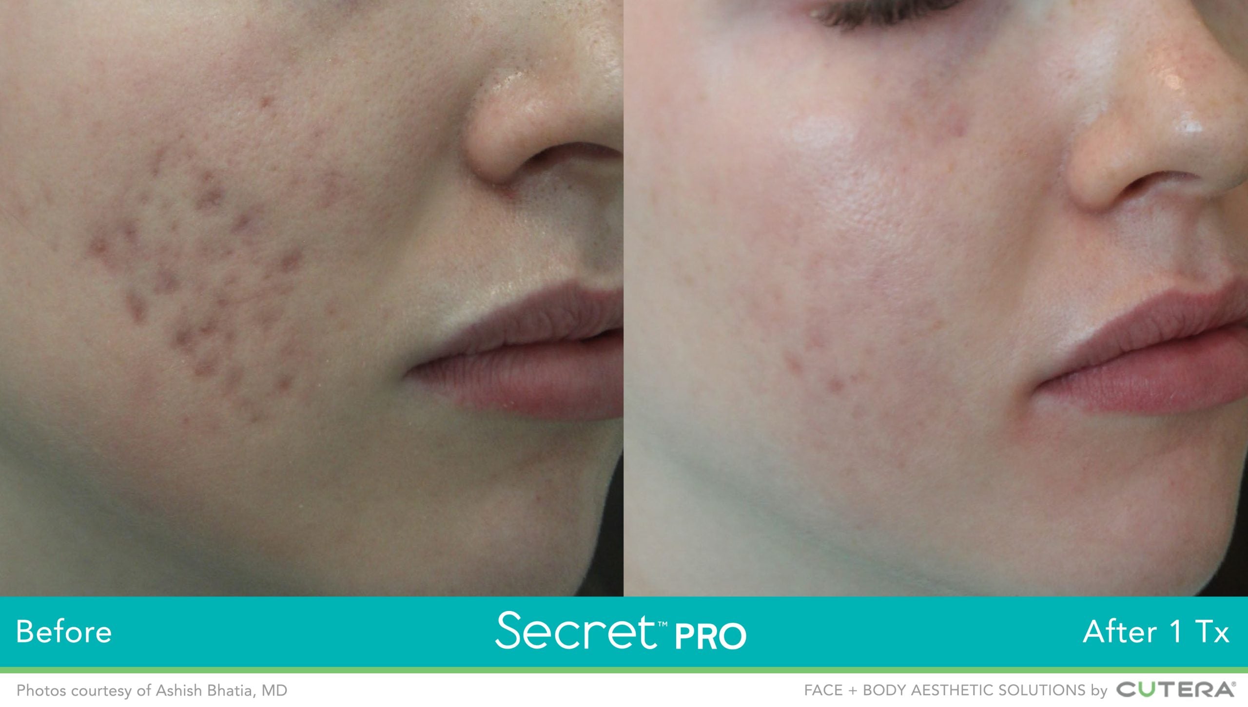 Secret PRO CO2 Ablative Laser Resurfacing save up to €500