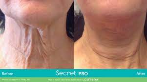 Secret PRO CO2 Ablative Laser Resurfacing save up to €851