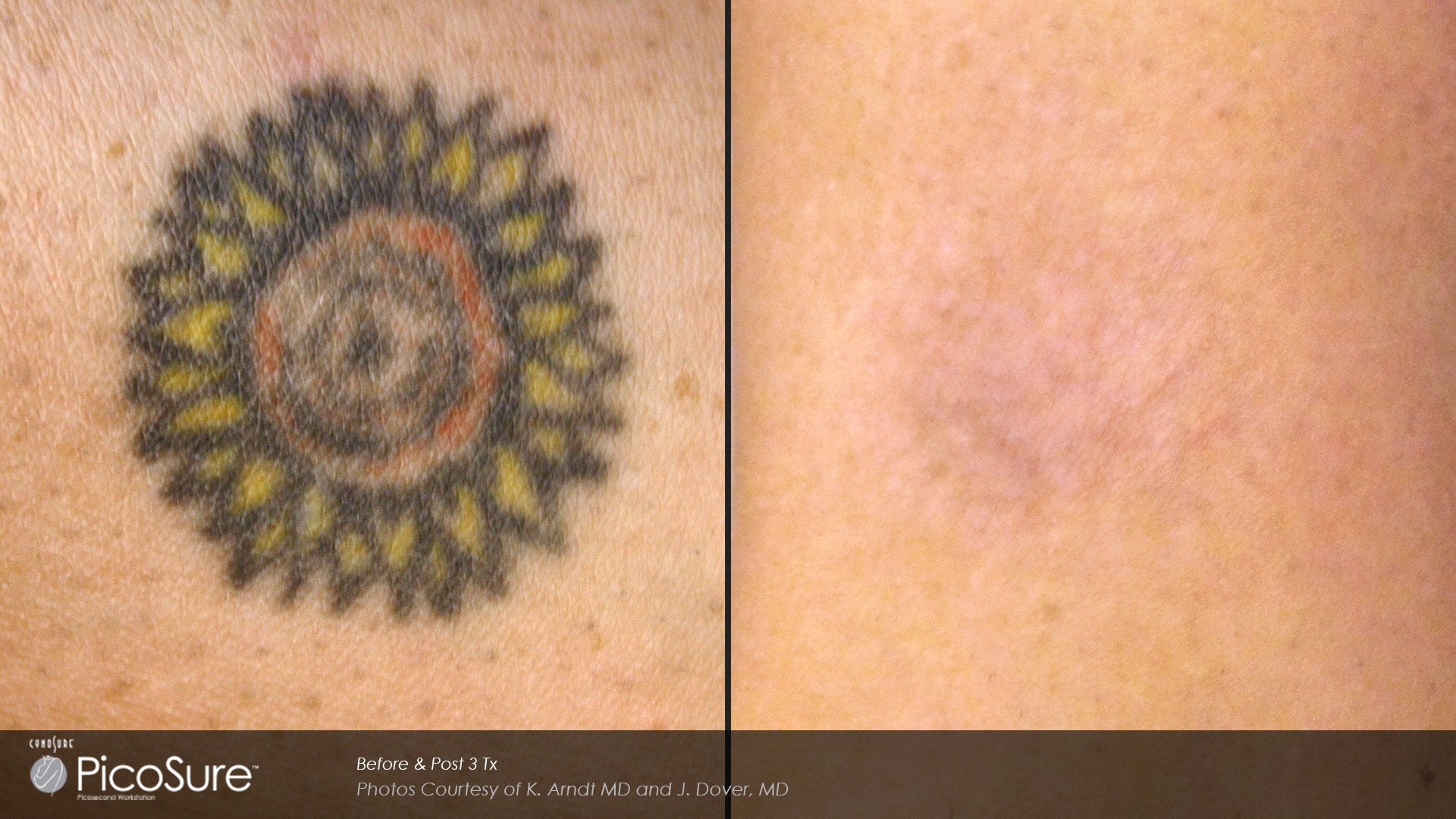 Picosure Laser Tattoo Removal save up to €500