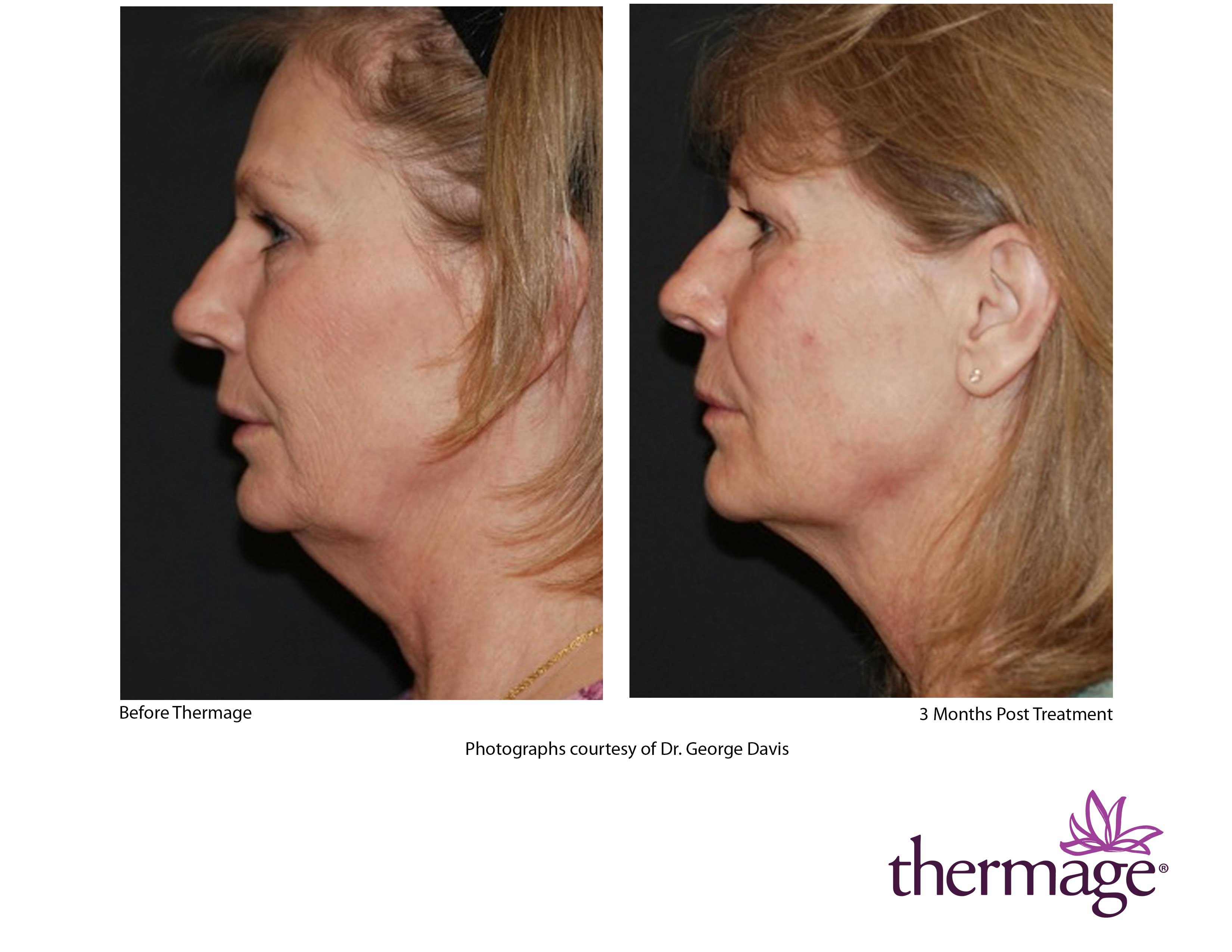 Thermage FLX RF Anti-Ageing Skin Tightening Treatment (save up to €501)