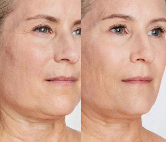 ultherapy before after south william clinic 3.jpg__PID:03169966-3224-45d2-b3e1-c14de0f7ddcf