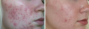 Skin Accumax 120 Capsules