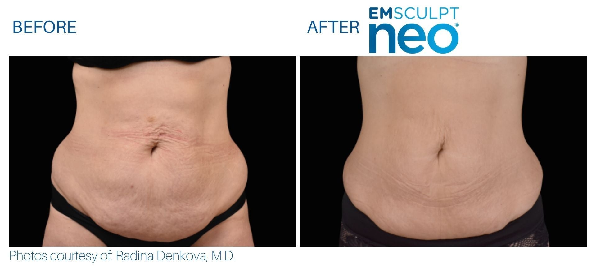 EmSculpt NEO Muscle Building & Fat Burning as low as €300 per session