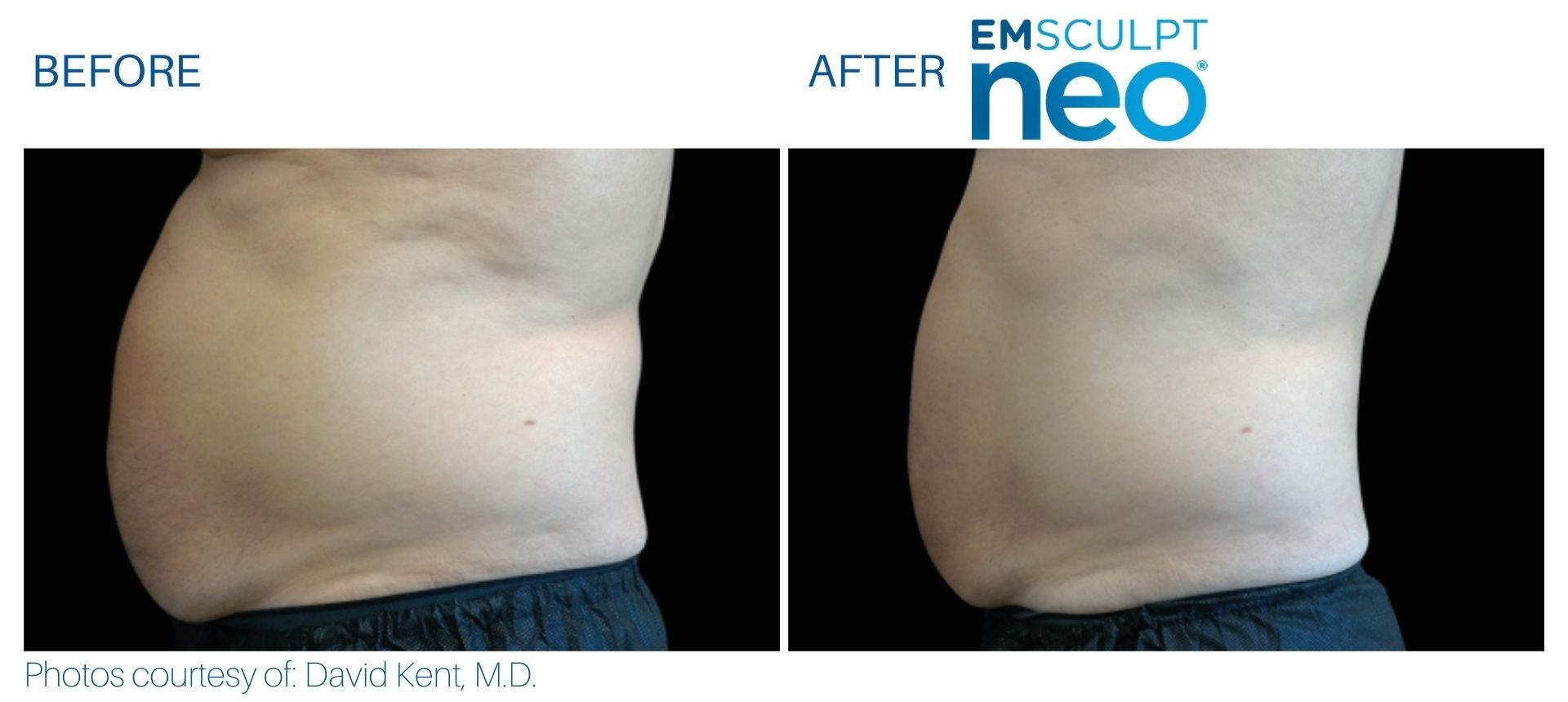 EmSculpt NEO Muscle Building & Fat Burning as low as €300 per session