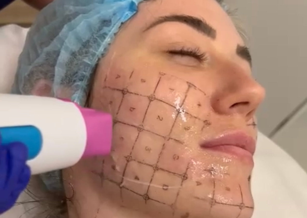 Thermage FLX full face or neck skin tightening (save €501)