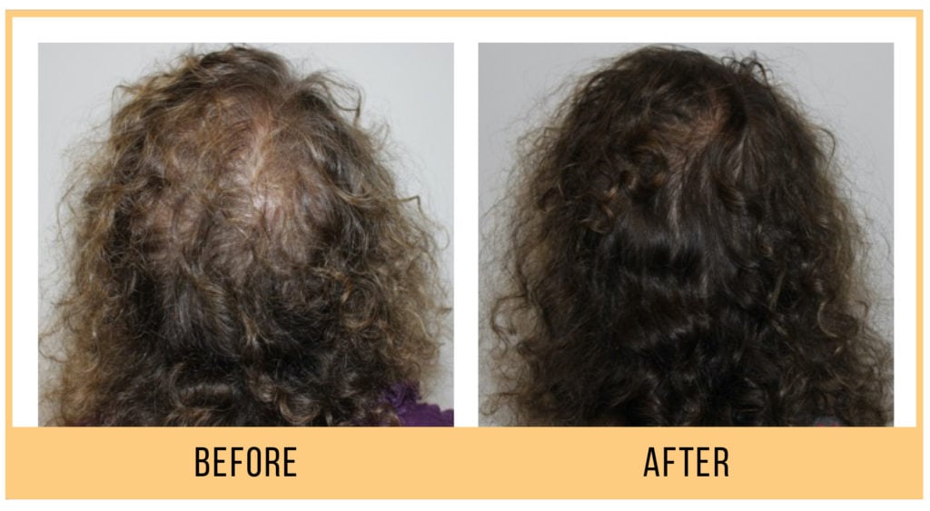 HydraFacial Keravive Scalp Health Treatment
