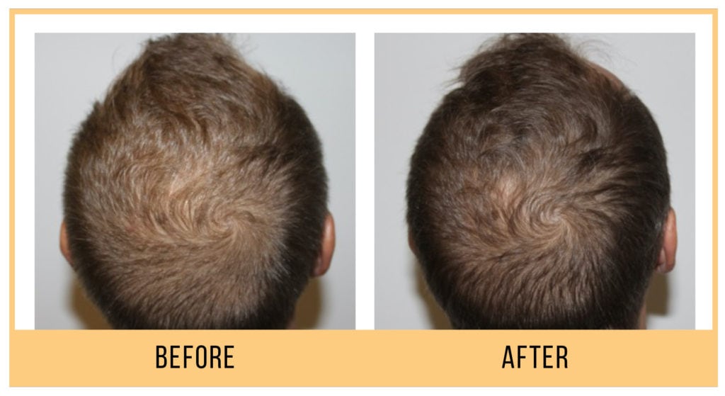 HydraFacial Keravive Scalp Health Treatment Course of 3 (save €200)