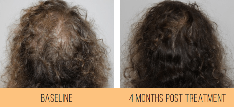 HydraFacial Keravive Scalp Health Treatment Course of 3 (save €200)