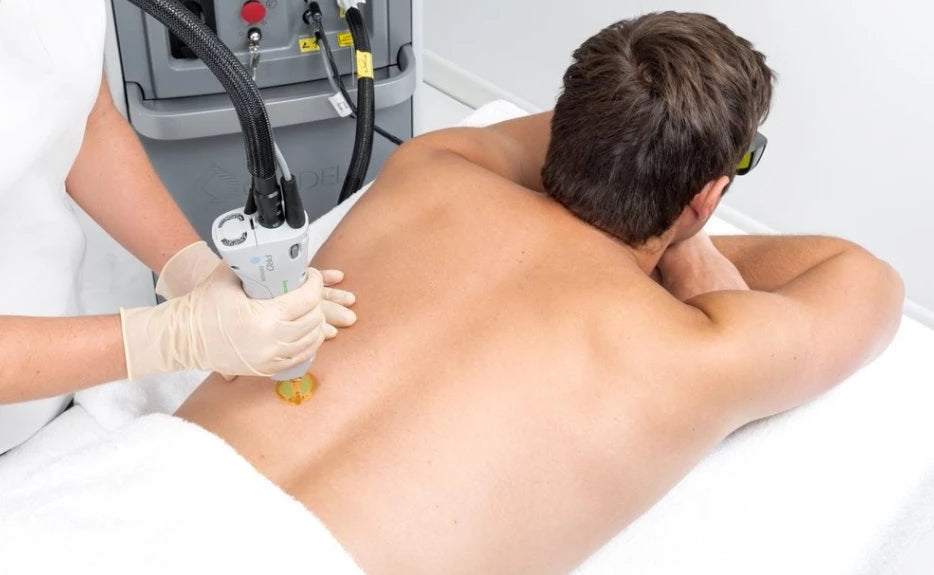 Laser for Men: Full back or full chest & stomach and shoulders (save €301)