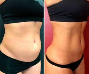 EmSculpt NEO Muscle Building & Fat Burning as low as €300 per session