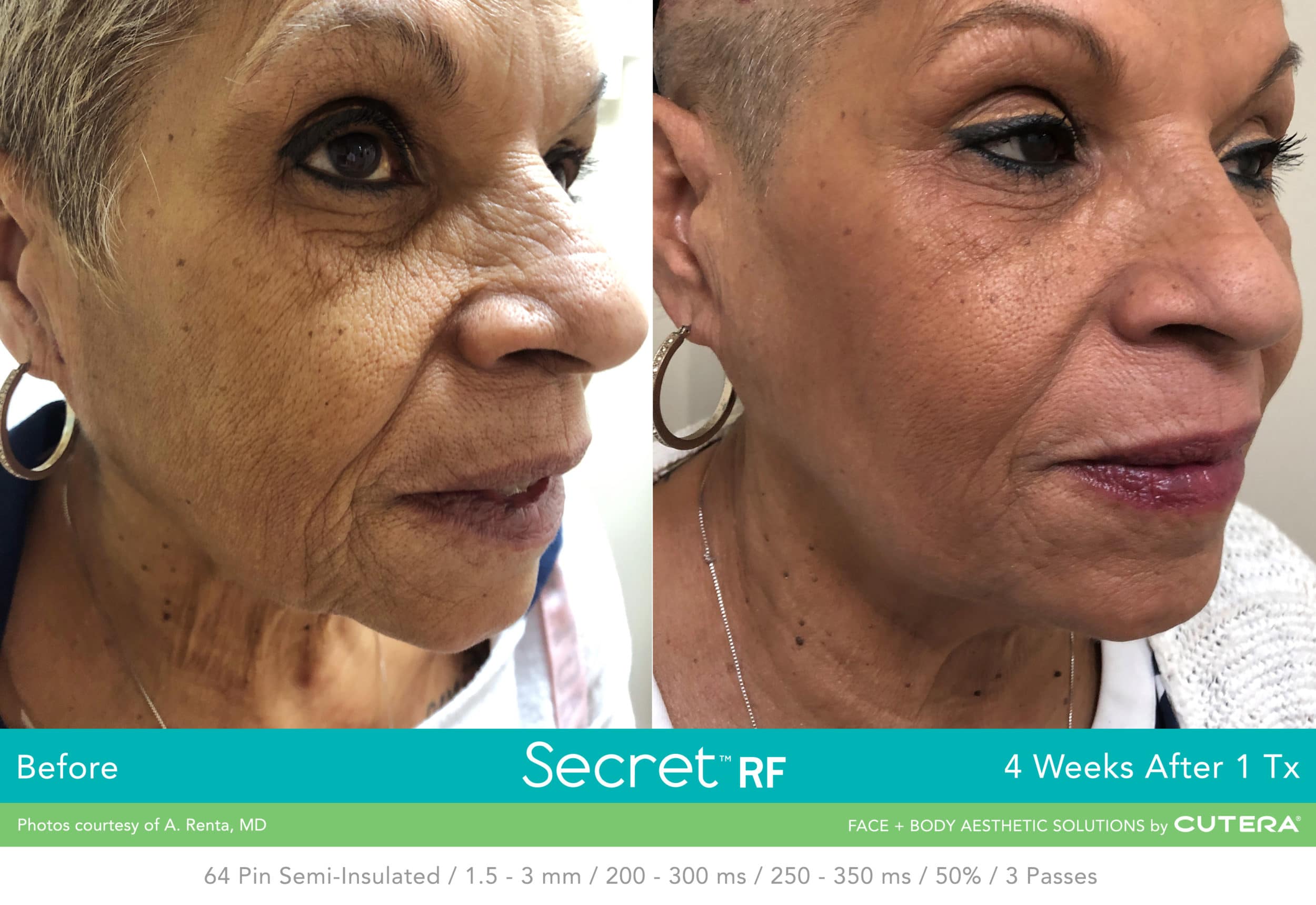 Secret RF Refine: RF+Microneedling Full Face Course of 3 (save 20%)