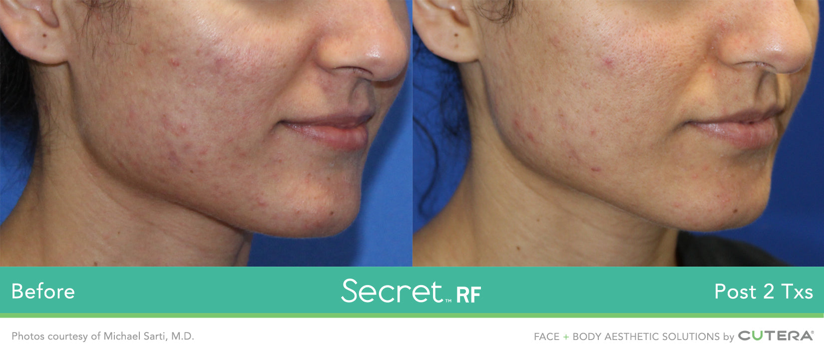 Cutera Secret RF +Microneedling with optional Exosomes (save up to €1,051)