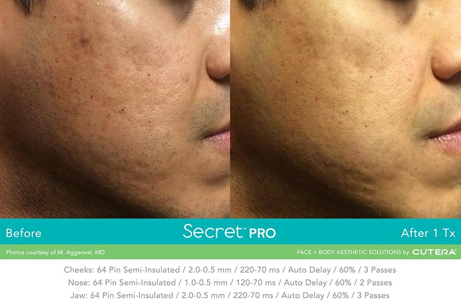 Secret RF Refine: RF+Microneedling Full Face Course of 3 (save 20%)