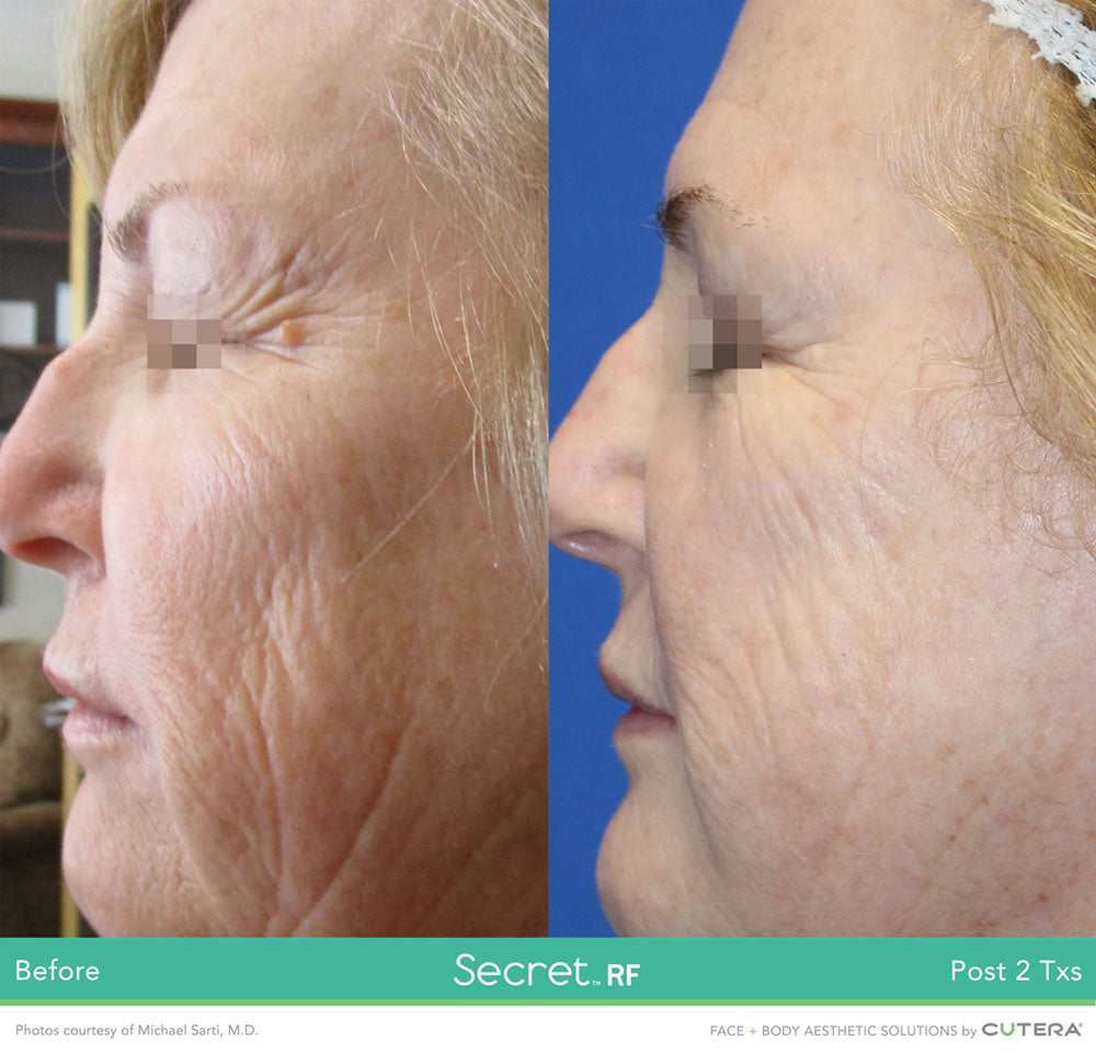 Secret RF Refine: RF+Microneedling Full Face Course of 3 (save 20%)