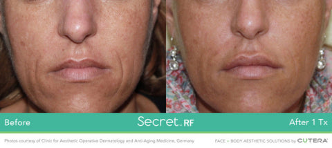 Secret RF +Microneedling Package with LED for Full Face or Face & Neck (save up to €501)