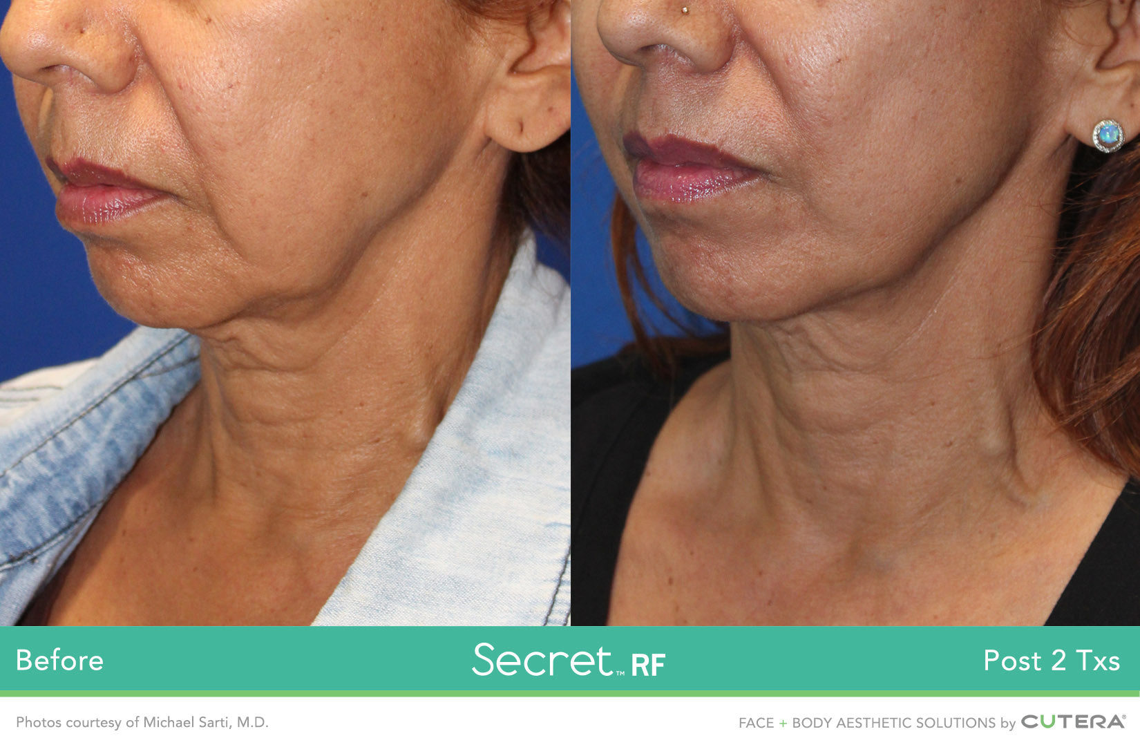 Secret RF Refine: RF+Micro-needling Full Face & Neck course of 3 (save 20%)