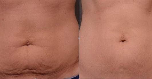 Secret PRO Refine: RF +Microneedling for Stretch Marks or Body course of 3 (save 20%)