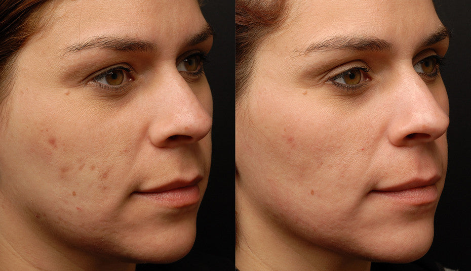 Sublative Skin Resurfacing course of 3 (Save €100)