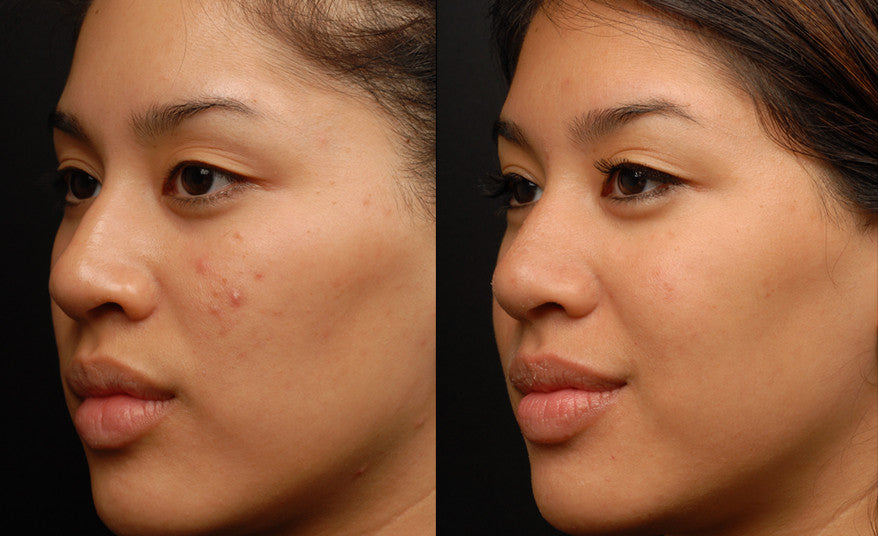 Sublative Skin Resurfacing course of 3 (Save €100)