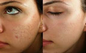 Sublative Skin Resurfacing course of 3 (Save €100)