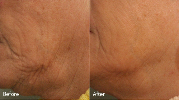 Sublative Skin Resurfacing course of 3 (Save €100)