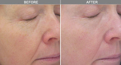 Sublative Skin Resurfacing course of 3 (Save €100)