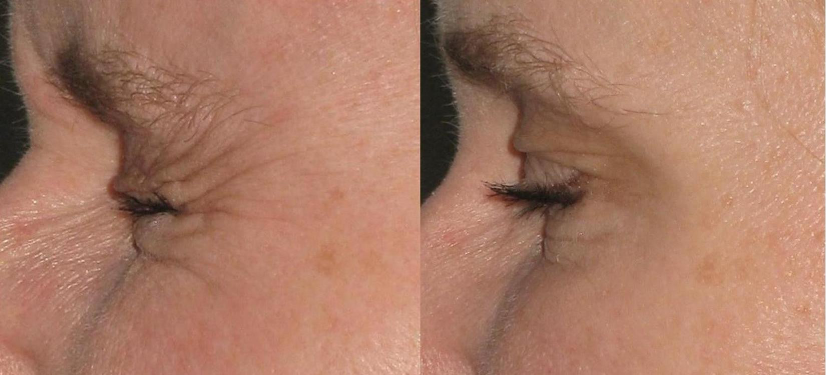 Sublative Skin Resurfacing course of 3 (Save €100)