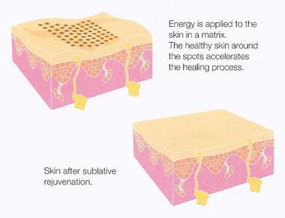 Sublative Skin Resurfacing course of 3